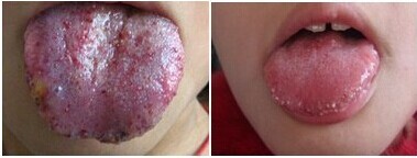 【诊断】女子一半舌头变成蓝色竟因这个(图1)