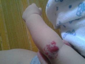 【治疗】菏泽5龄男童苦寻“开口”良医(图1)