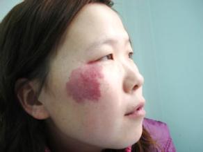 【治疗】盘点治疗鲜红斑痣3种有效方法(图1)