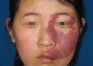 【症状】鲜红斑痣危害一般有哪些(图1)