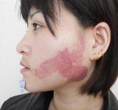 【病因】为什么会有那么多人患上鲜红斑痣(图1)