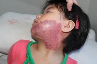 【防治】鲜红斑痣要怎么预防(图1)