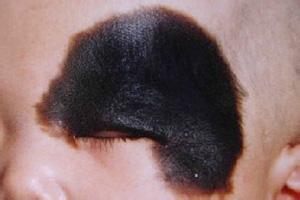 【防治】什么是太田痣(图1)