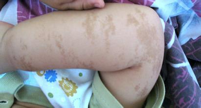 【科普】牛奶咖啡斑，你了解多少？(图1)