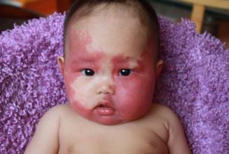 【科普】了解鲜红斑痣症状 及时治疗保健康(图1)