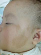 【病因】牛奶咖啡斑是什么?咖啡斑的形成原因(图1)