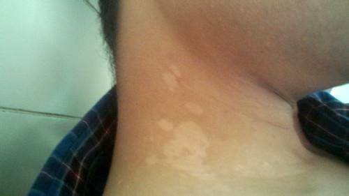 色素斑是怎么形成的(图1)