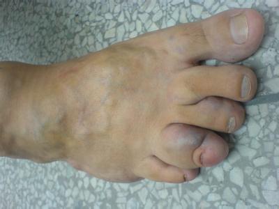 【病因】男子通宵夜班后玩手机游戏 诱发血管畸(图1)